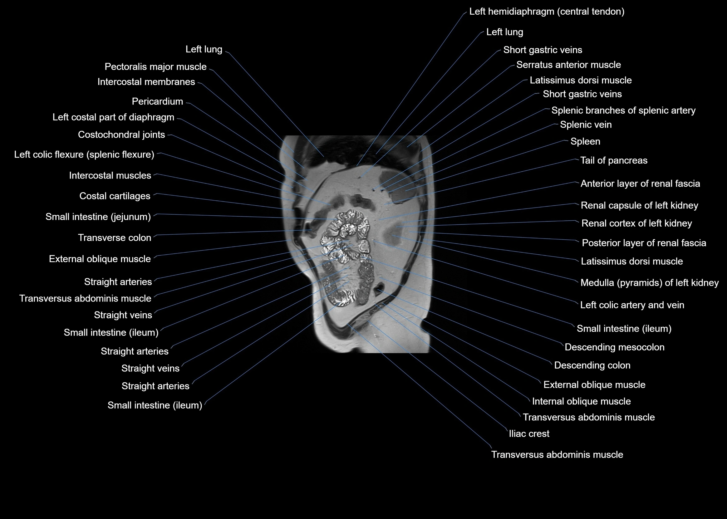 MRI abdomen sagittal cross sectional anatomy  radiology  image-img-00001-00057.webp